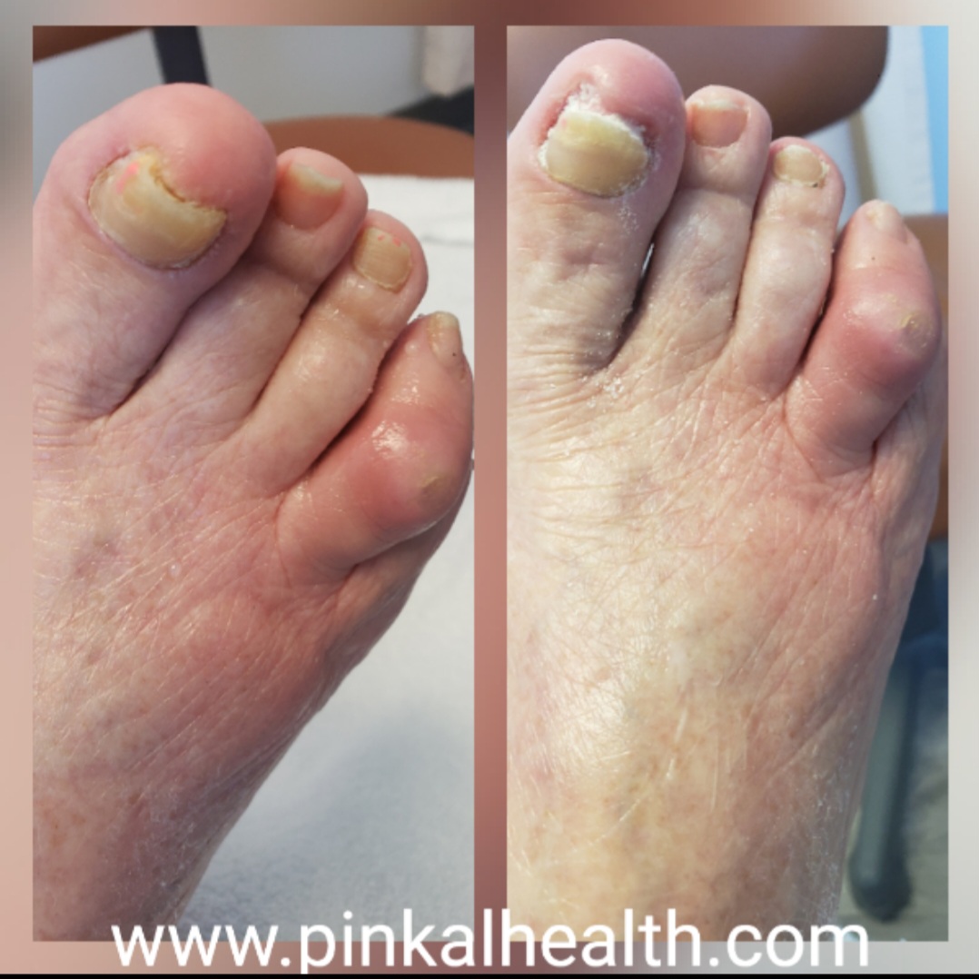 Foot Clinic at Pinkal - Best Medical Foot Care in London photo 2